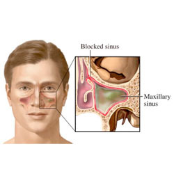 Tooth pain and sinuses: can a sinus infection cause a 