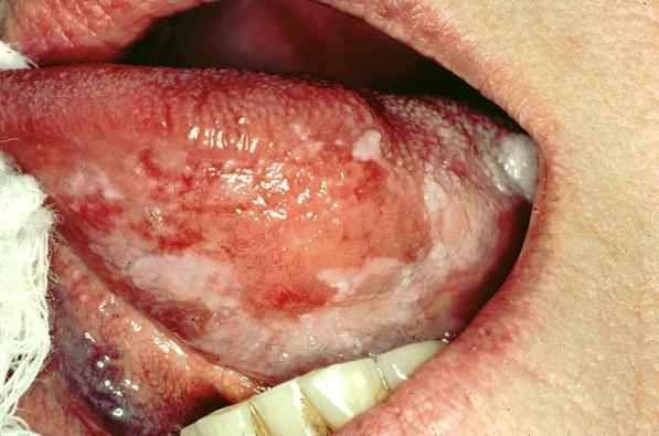 Pictures Of Oral Cancer On Side Of Tongue