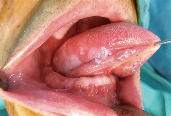 Tongue Cancer Pictures. What does tongue cancer look like?